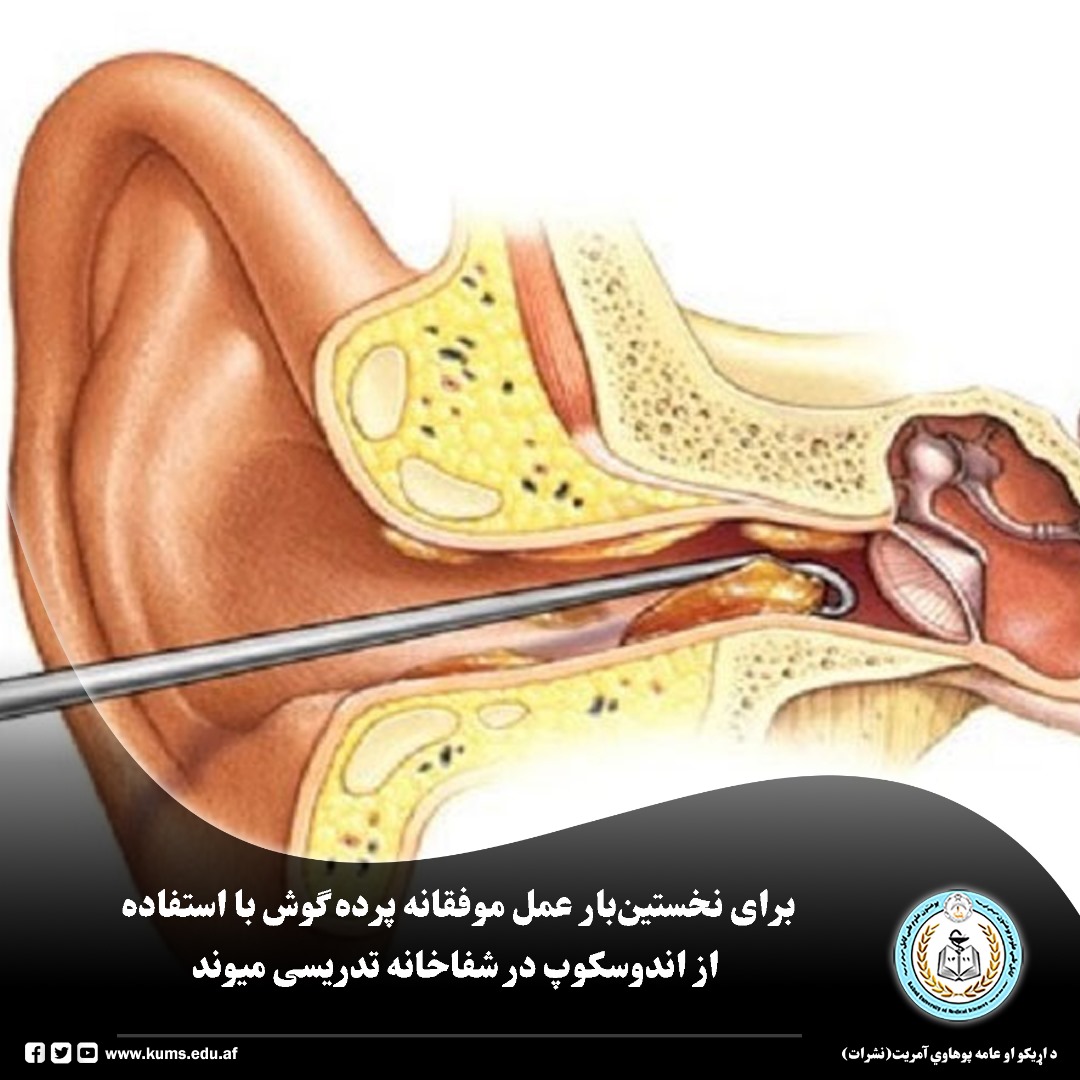 بر اساس گزارش شفاخانه تدریسی میوند برای نخستینبار به سطح شفاخانه های دولتی عمل جراحی پرده گوش (تیمپانوپلاستی) با استفاده از اندوسکوپ و روشهای جدید و معیاری در این شفاخانه به گونه موفقانه انجام شد.