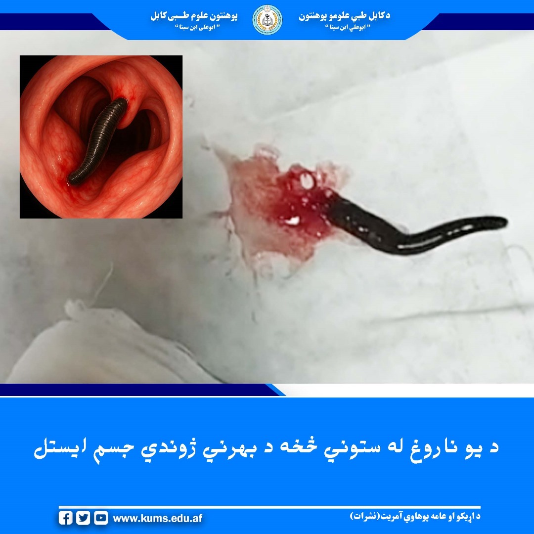د کابل طبي علومو پوهنتون اړوند میوند تدریسي روغتون د غوږ، ستوني او پزې څانګې ډاګټران د یو بریالي نادر عملیات خبر ورکوي چې پکې د یو ۵۰ کلن ناروغ له ستوني څخه د یو بهرني ژوندي جسم(ژوره) ایستل شوې ده.