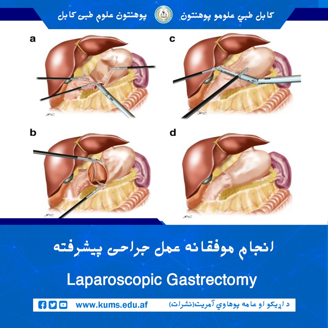 داکتران بخش آنکولوژی شفاخانه تدریسی علی‌آباد پوهنتون علوم طبی کابل عمل جراحی Laparoscopic   Gastrectomy توسط کمره را بالای بیمار ۳۷ ساله که از بندش در قسمت انتهایی معده (Pyloric Obstruction) رنج می‌برد، موفقانه انجام داد.
