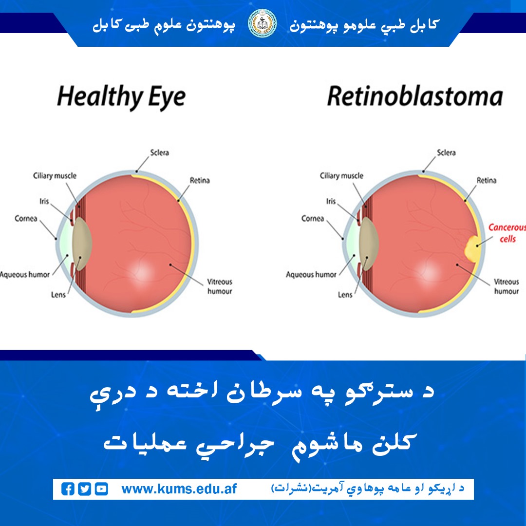 کودک سه‌ساله که از بیماری سرطان چشم (Retinoblastoma) در چشم راست خود رنج می‌برد، در شفاخانه تدریسی چشم پوهنتون علوم طبی کابل تحت عمل جراحی موفقانه قرار گرفت.