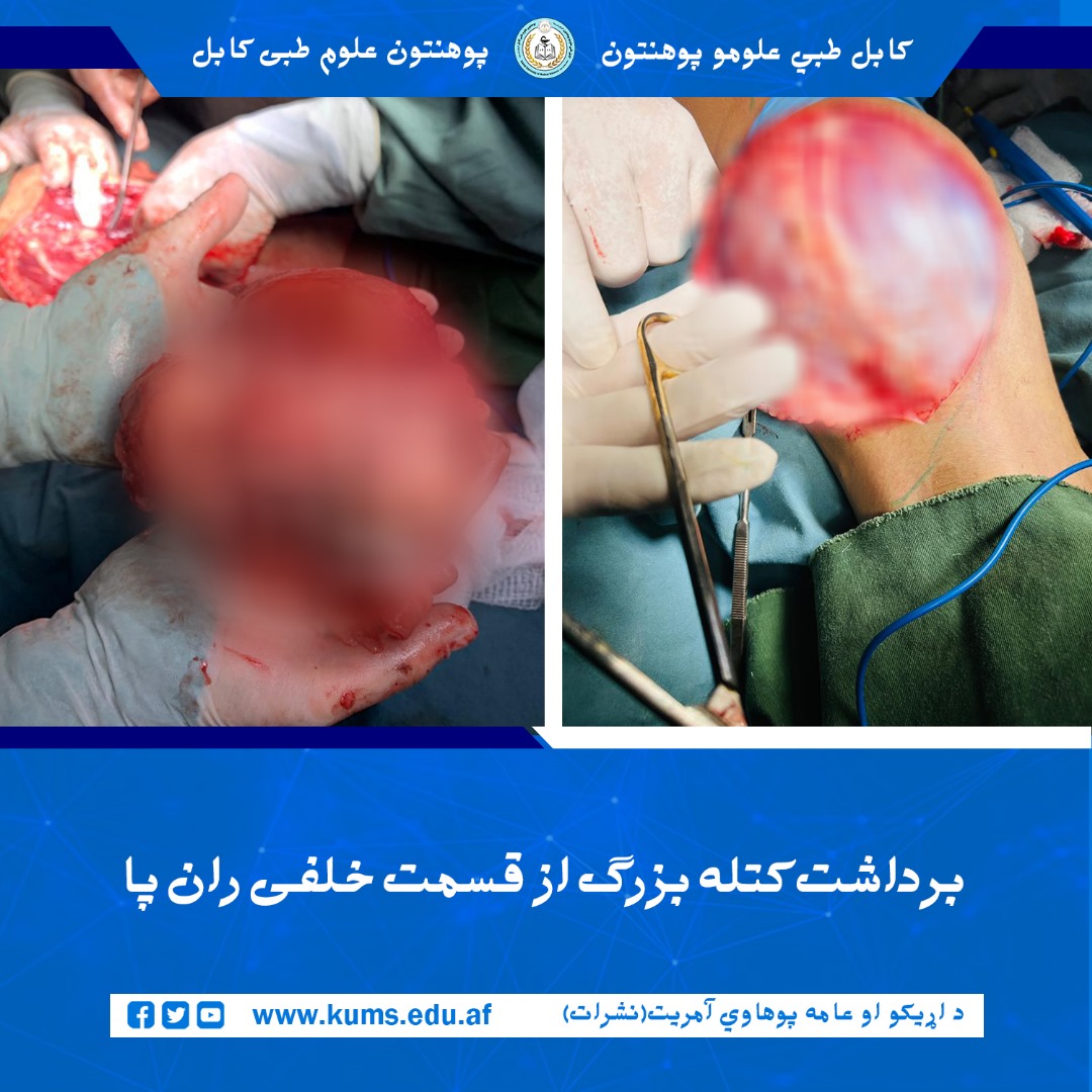 عمل جراحی برداشت تومور از قسمت خلفی( پشت) ران پا راست بیمار ۱۲ ساله توسط داکتران دیپارتمنت جراحی پلاستیک شفاخانه تدریسی میوند پوهنتون علوم طبی کابل«ابوعلی ابن سینا»  با موفقیت انجام شد.