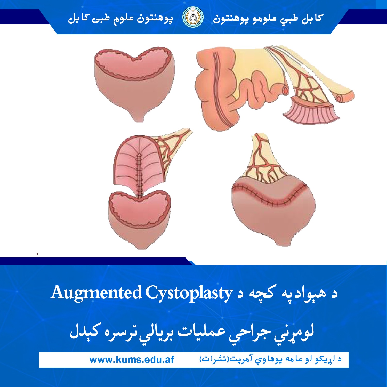 د کابل طبي علومو پوهنتون «ابو علي ابن سینا» د بطني جراحي او آنکولوژیکو ناروغیو او یورولوژي ډيپارټمنټونو په ګډې همکارۍ سره د هېواد په کچه لومړی ځل د یو ۲۵ کلن ناروغ د Augmented Cystoplasty پرمختللی او تخصصي جراحي عملیات ترسره شو.    