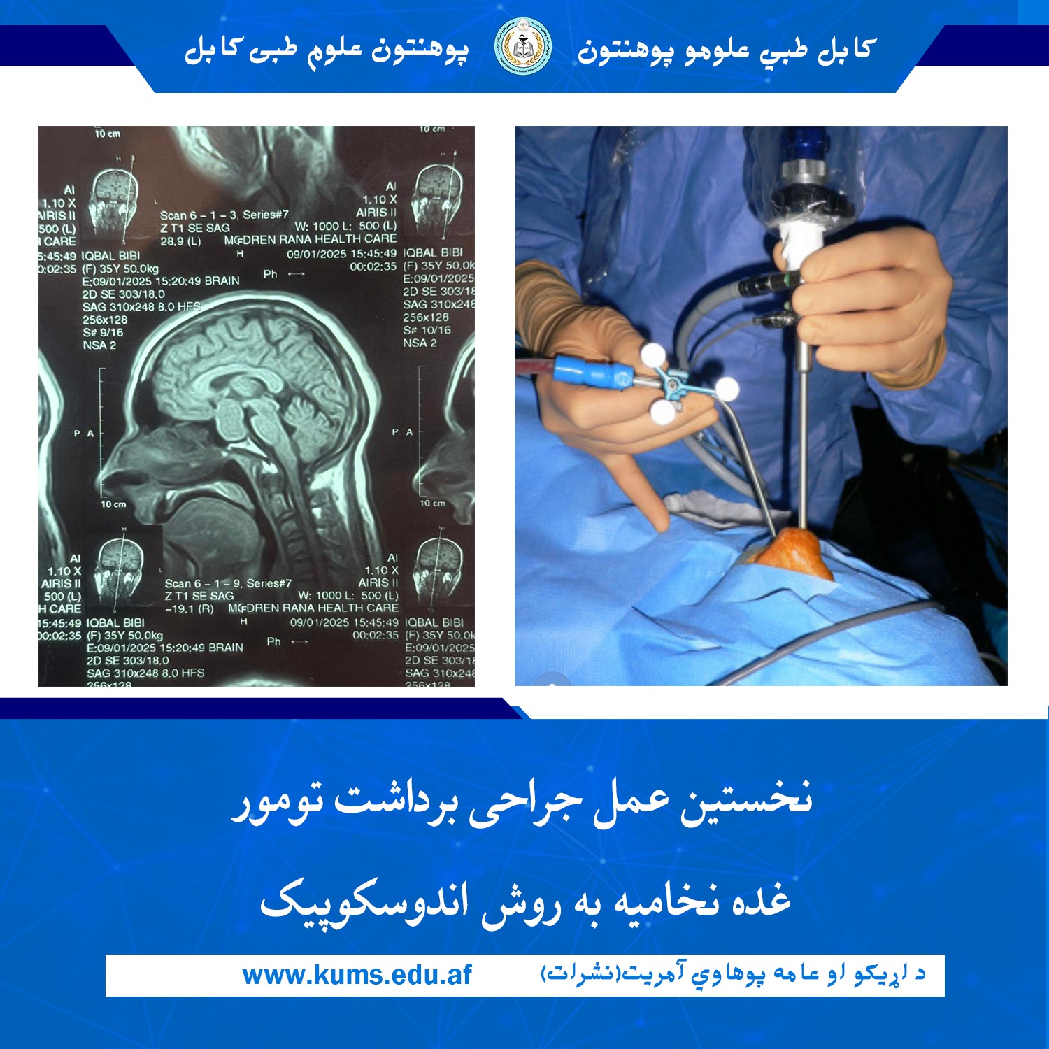داکتران دیپارتمنت جراحی اعصاب شفاخانه تدریسی علی آباد پوهنتون علوم طبی کابل « ابو علی ابن سینا» از انجام اولین عمل جراحی برداشت موفقانه تومور غده نخامیه به روش اندوسکوپیک بالای بیمار  ۴۵ ساله خبر میدهند. 