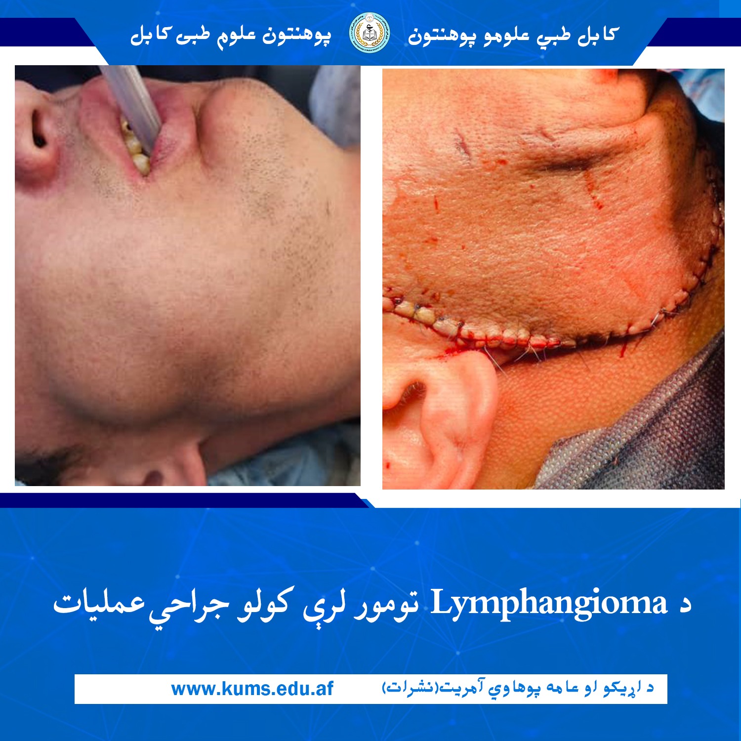 د کابل طبي علومو پوهنتون اړوند ستوماتولوژي تدریسي روغتون د ژامې جراحي ډيپارټمنټ ډاکټرانو د ډایکنډي ولایت اوسېدونکي یو ۳۰ کلن ناروغ د مخ او غاړې ښي اړخ Lymphangioma تومور ایستلو جراحي بریالی عملیات ترسره کړ.