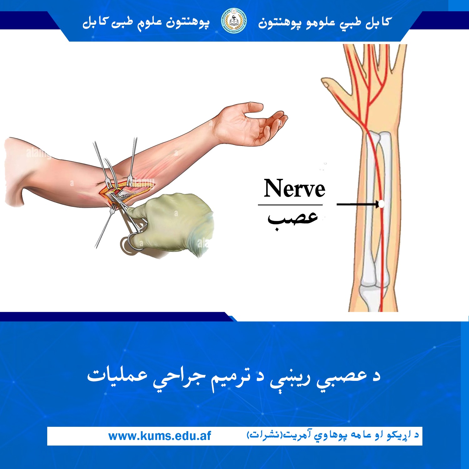 د کابل طبي علومو پوهنتون «ابو علي ابن سینا» اړوند میوند تدریسي روغتون د پلاستیک جراحي ډيپارټمنټ ډاکټرانو د یو ۳۲ کلن ناروغ د کيڼ لاس پرې شوې عصبي ريښې بیا ځل تړلو او ترمیم جراحي بریالی عملیات ترسره کړ. 