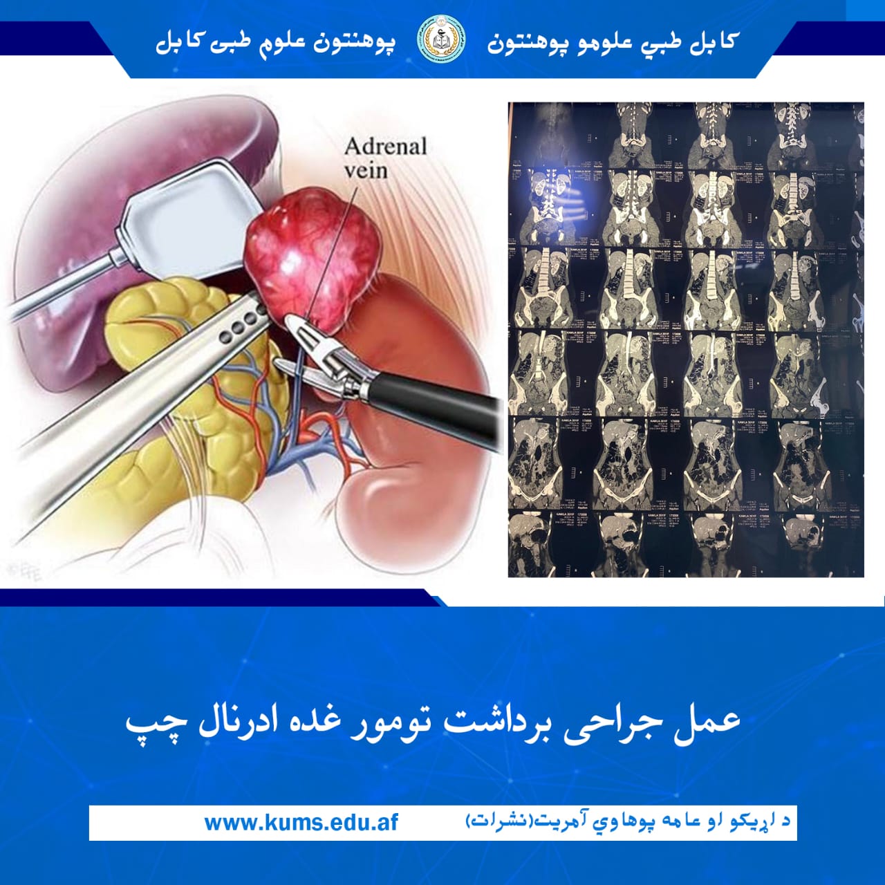 عمل جراحی برداشت تومور بزرگ غده ادرنال چپ (Left Adrenalectomy) بیمار ۳۵ ساله توسط داکتران دیپارتمنت جراحی بطنی و آنکالوژی بطنی شفاخانه تدریسی علی آباد پوهنتون علوم طبی کابل«ابو علی ابن سینا» با موفقیت انجام شد. 