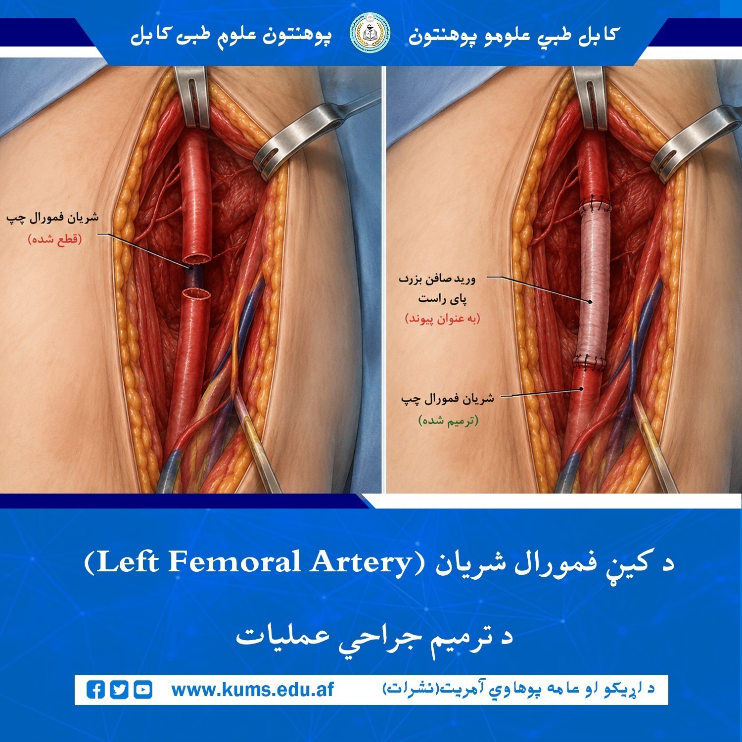عمل جراحی ترمیم شریان فمورال چپ (Left Femoral Artery) بیمار ۲۰ ساله از ولایت زابل در دیپارتمنت جراحی عمومی شفاخانه تدریسی علی‌آباد به همکاری داکتران دیپارتمنت جراحی صدری انستیتیوت امراض صدری و قلبی وعایی پوهنتون علوم طبی کابل «ابوعلی ابن سینا»  انجام شد.