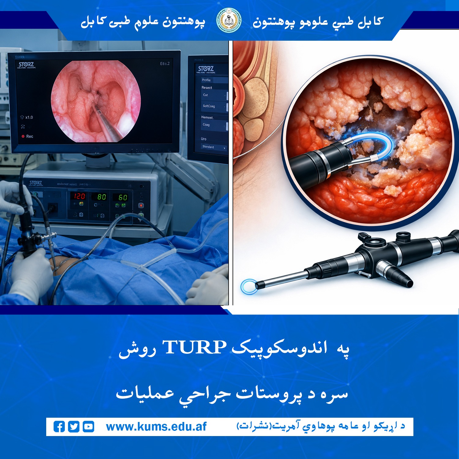 عمل جراحی اندوسکوپیک پروستات به روش  (Transurethral Resection of the Prostate - TURP)  بالای بیمار ۶۰ ساله مبتلا به بزرگی غده پروستات در دیپارتمنت یورولوژی شفاخانه تدریسی علی‌آباد پوهنتون علوم طبی کابل «ابوعلی ابن‌سینا» با موفقیت انجام شد.