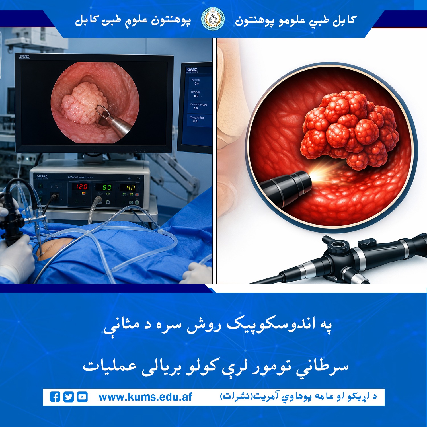 د کابل طبي علومو پوهنتون «ابو علي ابن سینا» اړوند علي آباد تدرییسي روغتون د یورولوژي ډيپارټمنټ ډاکټرانو په اندوسکوپيک (Transurethral Resection of Bladder Tumor - TURBT) روش سره د یو ۵۵ کلن ناروغ د مثانې سرطاني تومور عملیات بریالی ترسره کړ. 